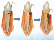珠海維港口腔科普——牙周病有咩分類咧？