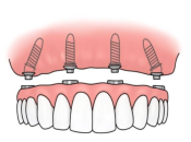 珠海半口植牙，All-on-4種植牙幾錢？