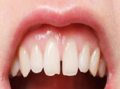 珠海補牙，牙縫大可以補牙嗎？